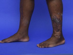 psoriasis-dark-skin__protectwyjqcm90zwn0il0_focusfillwzi5ncwymjisingilde5xq-8339266-6205744