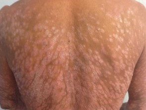 Psoriasis severa que afecta la espalda.