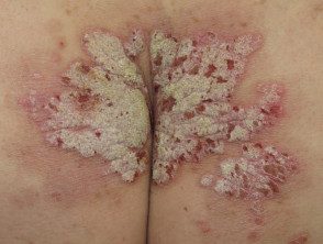 psoriasis-severe-buttocks__protectwyjqcm90zwn0il0_focusfillwzi5ncwymjisingildexxq-1800178-8905247