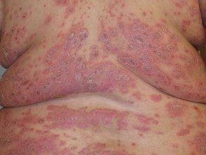 Psoriasis severa