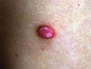 Granuloma piógeno