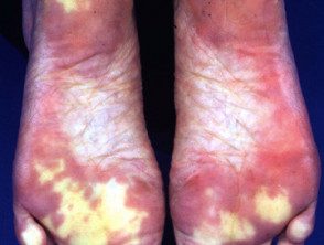 raynaud-feet__protectwyjqcm90zwn0il0_focusfillwzi5ncwymjisinkildg1xq-9208807-1485154