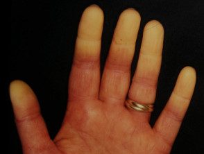 Fenómeno de Raynaud