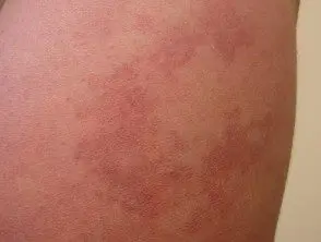 Nevus vascular reticular