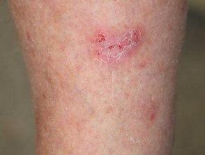 Carcinoma superficial de células basales, pierna