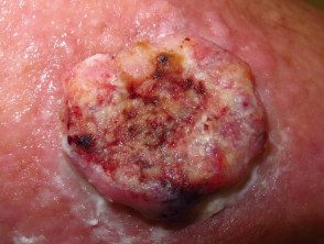 Carcinoma de células escamosas cutáneas de alto riesgo.