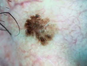 Dermatoscopia de carcinoma intraepidérmico