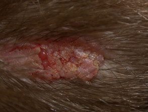 Nevus sebáceo con carcinoma basocelular