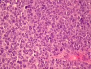 small-cell-malignant-melanoma__protectwyjqcm90zwn0il0_focusfillwzi5ncwymjisingildfd-9937852-5318290