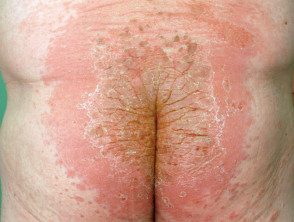Alergia al dimetilfumarato: dermatitis del sofá