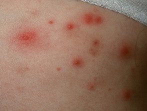 Foliculitis gramnegativa