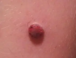 Melanoma spitzoid en la pierna de un niño