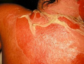 Síndrome de piel escaldada estafilocócica