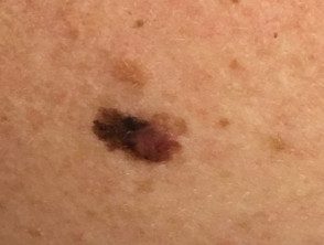 Melanoma de diseminación superficial