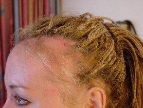 Alopecia de tracción