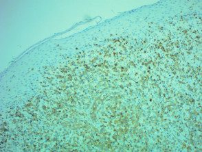 Patología micosis fungoide transformada teñida con CD3 x100