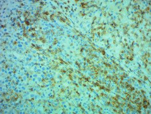 Patología micosis fungoide transformada teñida con CD4 x200