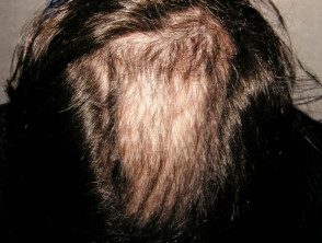 trichotillomania 03