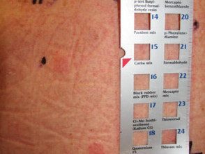 Serie basal de alergenos de prueba de parche