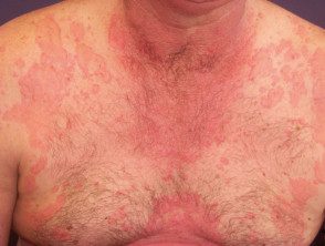 Urticaria