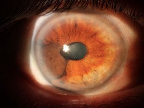 Uveal / melanoma del iris