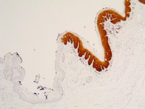 Patología vulvar de la neooplasia intraepitelial con tinción p16 x40