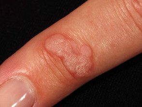 Virus del papiloma manos - Problema cu tratamentul viermilor