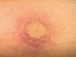 Reacción de picadura de avispa que causa vasculitis loalizada con púrpura