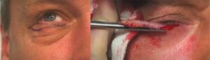 classic-eyelid-resection-1350176