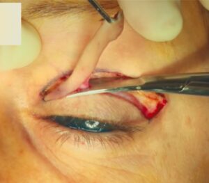 resection-skin-eyelids-4176660