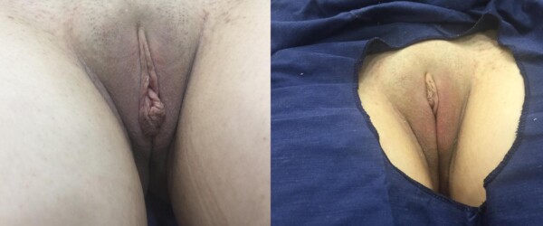 labiaplastie au laser buenos aires
