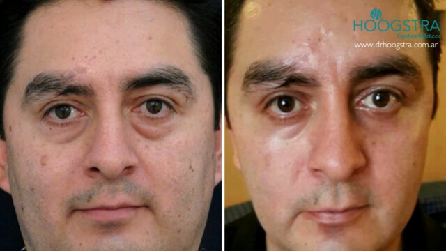 postoperative eyelids man
