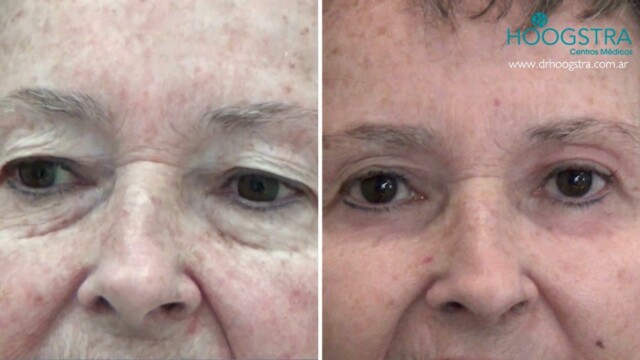 blepharoplasty results woman