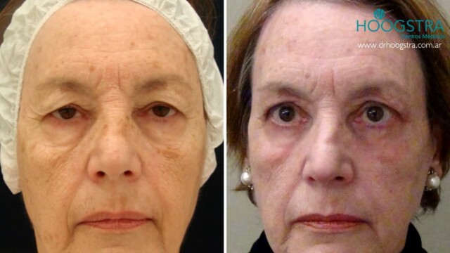 opinion blepharoplasty in buenos aires