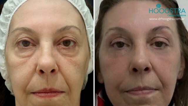 eyelid rejuvenation