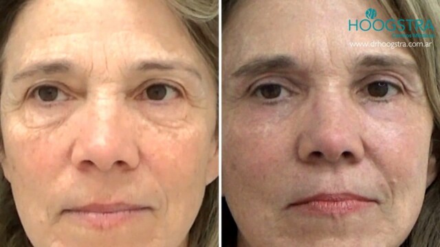 blepharoplasty before and after