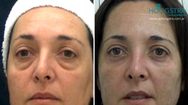 Blepharoplasty without surgery results