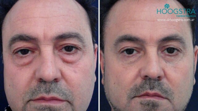 blepharoplasty in men