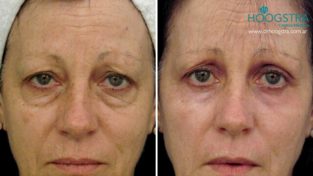 laser blepharoplasty reviews