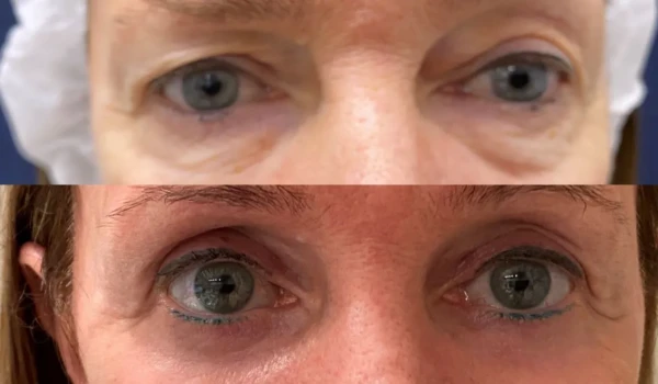 before-after-intervention-eyelids