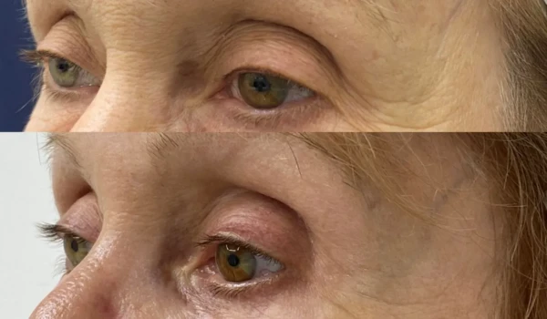 eyelid-surgery-comparison