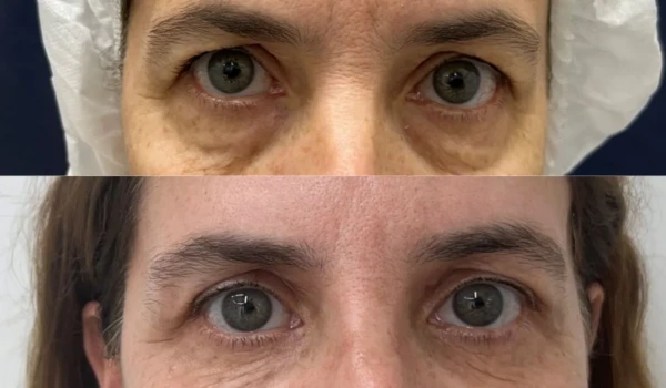 before-after-blepharoplasty