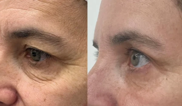 rejuvenation-eyelids