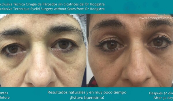 eyelid surgery
