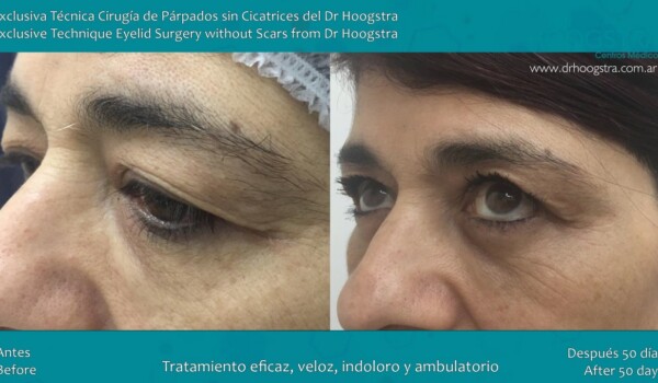 eyelid surgery