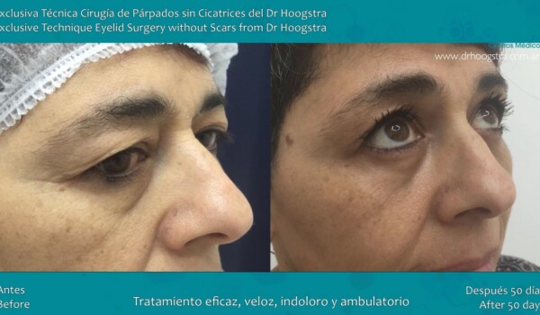 eyelid surgery