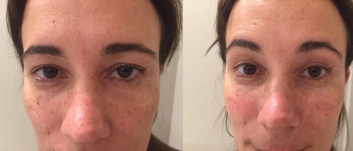 hyaluronic acid treatment bags