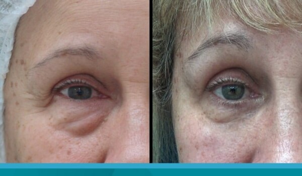 eyelids treatment