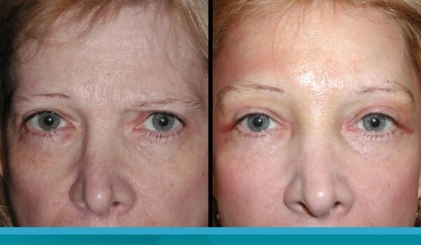 blepharoplasty without surgery