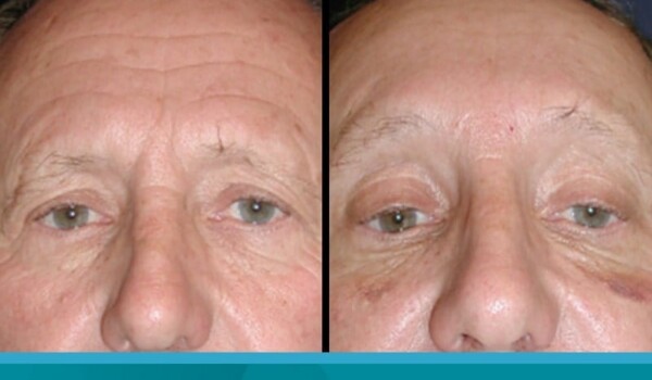 laser eyelid surgery